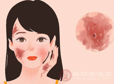 红斑狼疮患者的皮肤上会出现红色斑块，尤其是在暴露在阳光下的部位，如脸部、关节、胸部等
