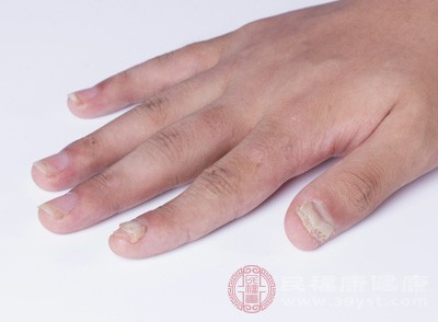 指甲上的“豎紋”，醫學上稱為甲縱溝，是指從指甲根部向指尖方向延伸的縱向條紋
