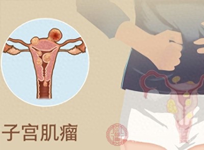 子宫肌瘤喜欢长在哪个位置 出现这几个症状该重视了