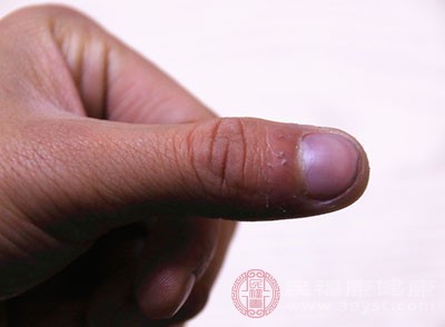 早上起床之后发现手指僵硬的话往往可能是类风湿性关节炎的影响