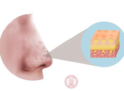 直接拔鼻毛，會對鼻腔內(nèi)的毛囊造成損傷，影響鼻毛的生長