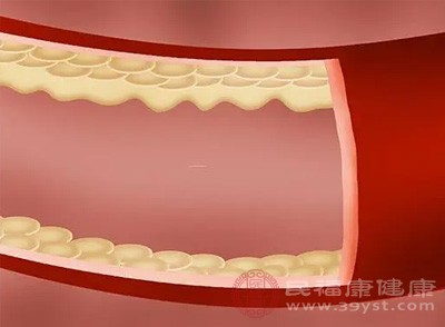 血管堵塞人体会有哪些表现 疏通血管应注意什么