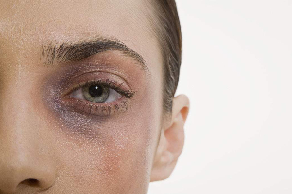 血流经过此处的大静脉,在特别接近皮肤表层下方便会出现蓝黑色的眼晕