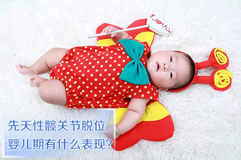 先天性髋关节脱位婴儿期有什么表现