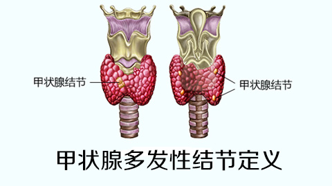 甲状腺多发性结节定义