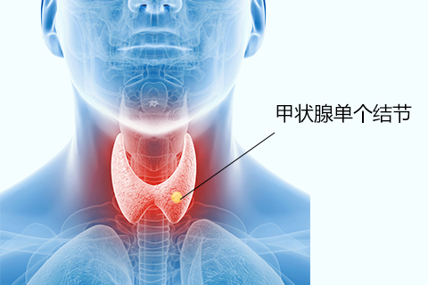 甲状腺单个结节就是在甲状腺上生长了一个结节