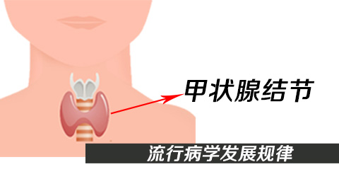 甲状腺结节流行病学发展规律