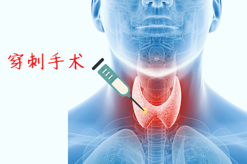 穿刺检查是确诊甲状腺结节主要的初筛手段，准确率比较高，能分辩出良性和恶性的病变，对诊断慢性甲状腺炎和急性甲状腺炎也有很高特异性。