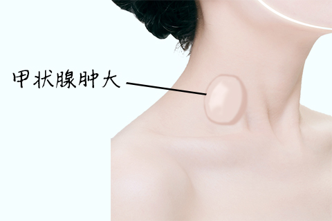 　甲状腺热结节是甲状腺结节的一种类型，除了正常的体征之外，由于热结节常伴随着甲状腺亢进疾病，因此在体征上还表现出甲亢、甲亢突眼体征。