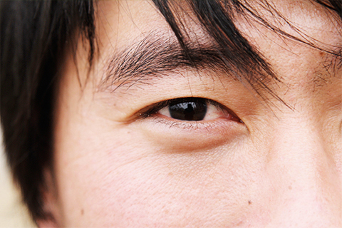 眼袋就是眼睛下面的皮肤缺少水分、缺少胶原蛋白、水肿等原因造成的