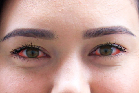 红眼病的疾病类型是什么