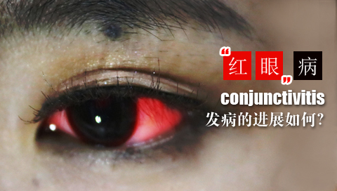 红眼病发病的进展如何