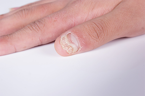 灰指甲是生活中常见的疾病,是由于真菌感染了甲板或者甲下引起的疾病