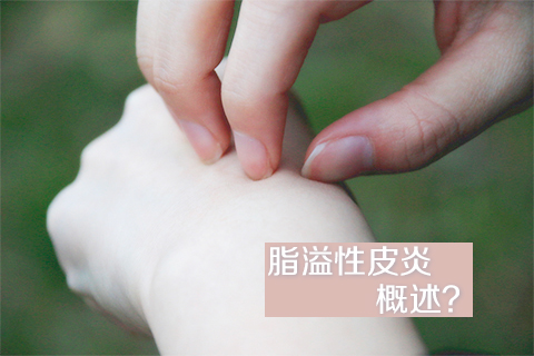 脂溢性皮炎概述