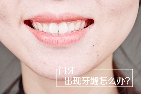 门牙出现牙缝怎么办