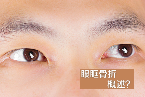 眼眶骨折概述