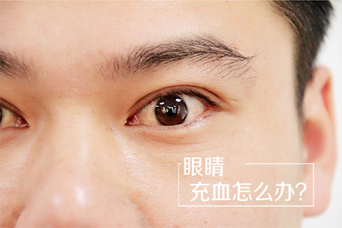 眼睛充血怎么办