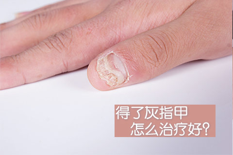 得了灰指甲怎么治疗好