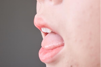 口干舌燥可能是因为外感风热造成的