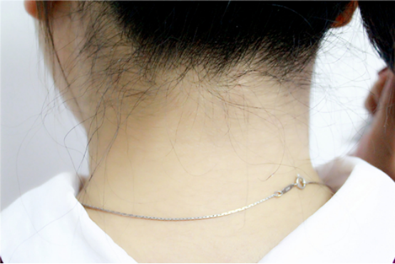 淋巴长痘怎么回事