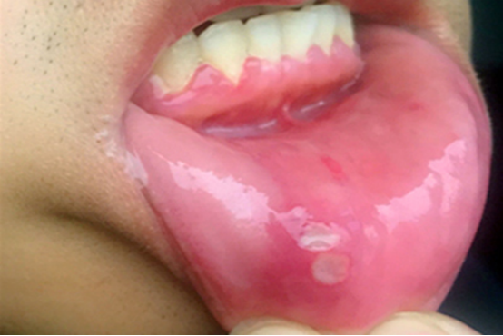口腔溃疡是由于口腔内粘膜出现白色疱疹的现象,患者在患有口腔溃疡后