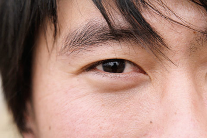 青光眼怎么治疗