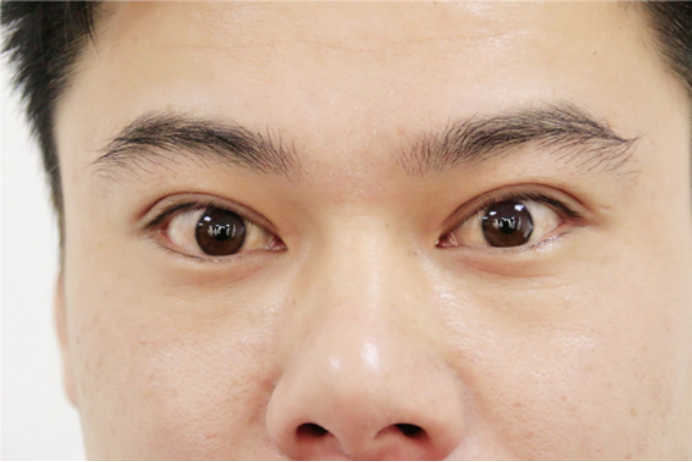 相信大家都知道眼睛有红血丝，其实每个人的眼睛里面都会有红血丝，只是大部分人眼中的红血丝都不是特别是明显