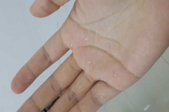 身上出水泡是什么原因引起的