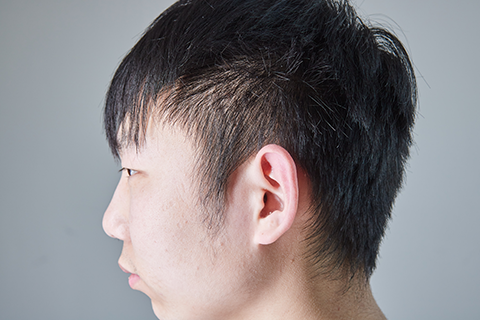 病人有严重的脑内虫蛀感