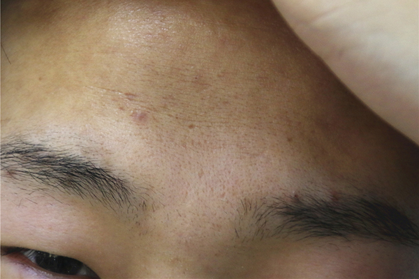 麻子脸如何治疗