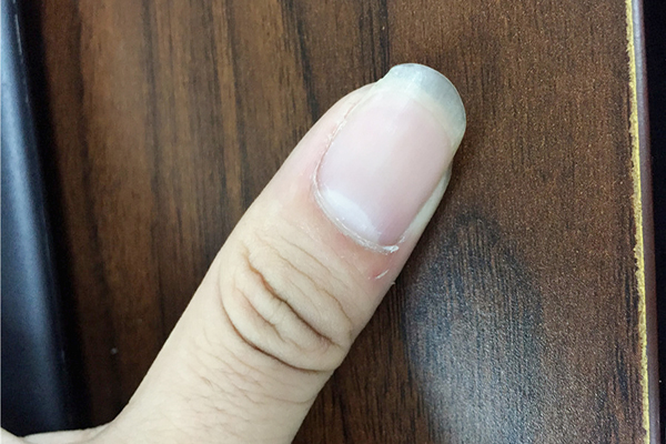 生活中，很多人会通过拇指的异常来判断自己的身体是不是出现了什么状况