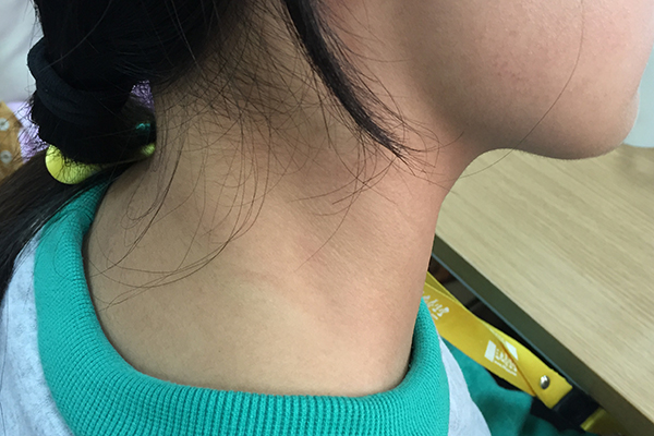 随着甲状腺疾病的患病率越来越高，人们也开始关注甲状腺的健康