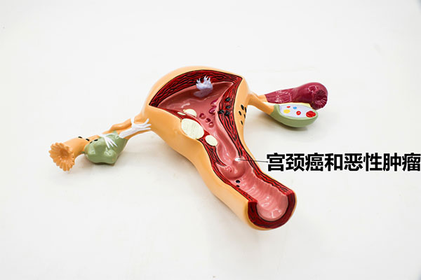 宫颈癌相信许多人都不陌生，这是很常见的一种疾病
