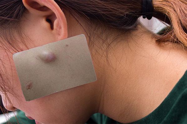 身上长小肉瘤是怎么回事