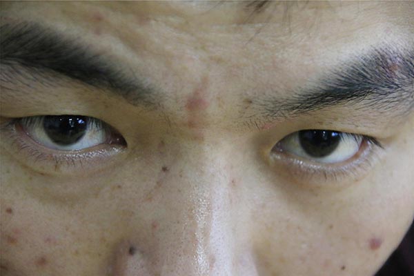 水痘印怎么消除