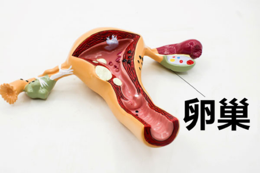 卵巢囊肿扭转是卵巢囊肿疾病的一种急腹症。