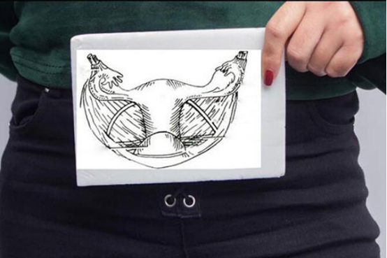 子宫纵隔是一种子宫发育异常的疾病，而他也属于是很严重的妇科疾病，这样的情况会导致女性朋友们很容易被出现不孕或者是胎停育、早产、反复流产等