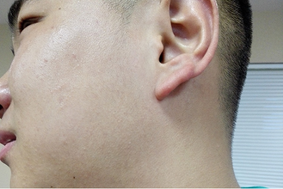 增厚皮肤角质层的方法 增厚皮肤角质层的方法