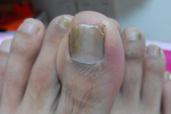 针对甲沟炎化脓的情况，患者可以采取用酒精消毒的办法来缓解病情。