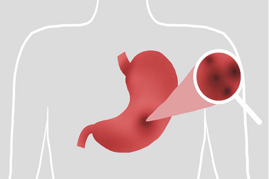 胃溃疡或者是胃出血，都会导致人们在半夜的时候出现胃疼的情况