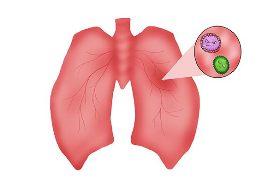 普通肺炎感染吗