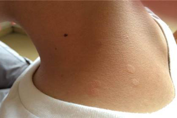 汗斑如何形成的这样会容易长汗斑