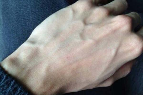 肝硬化身体这个部位青筋暴突可能是你的肝已经硬化了