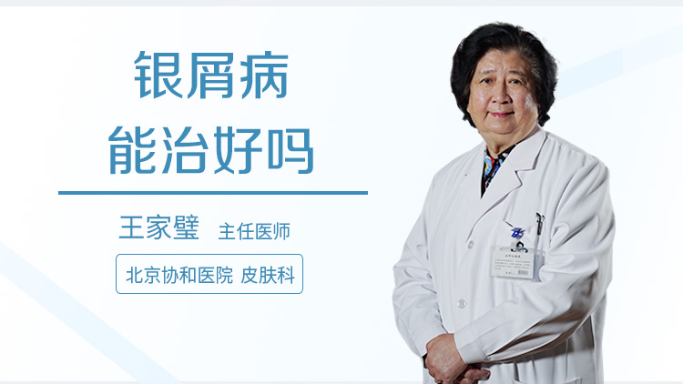 银屑病能治好吗