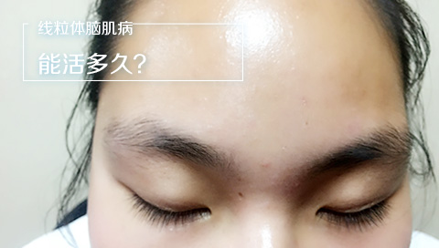 线粒体脑肌病能活多久