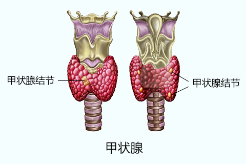 这种情况被称作是甲状腺多发性结节