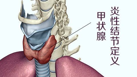 甲状腺炎性结节定义