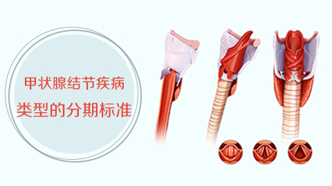 甲状腺结节疾病类型的分期标准
