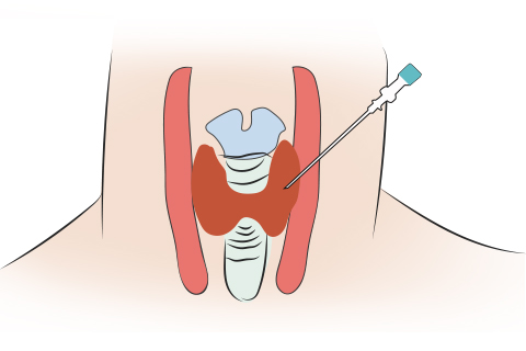 甲狀腺結節治療中的注意事項