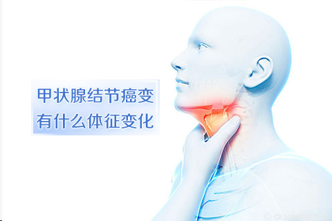 甲状腺结节癌变有什么体征变化